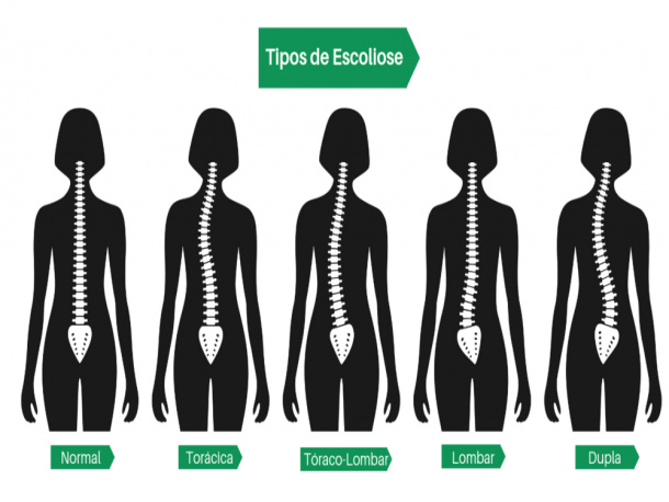 Junho Verde Alerta Para A Escoliose (19) 98143-0974 Whatsapp